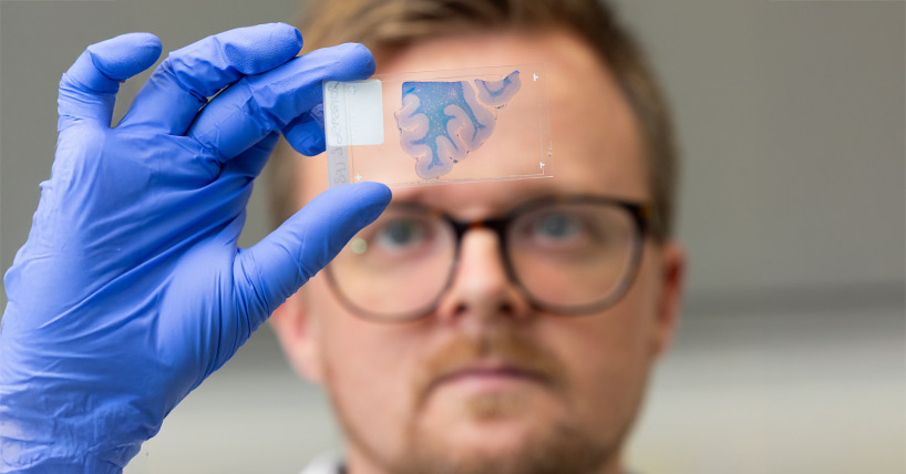 Dr Daniel Erskine examines brain tissue from a donor who had DLB
